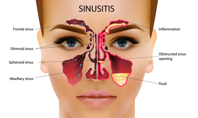 blocked sinus