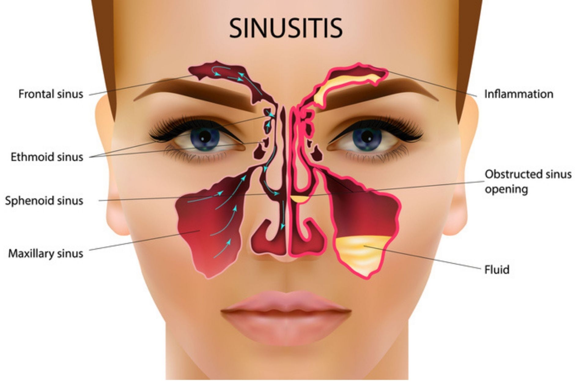 Sinus Problems Natural Solutions That Work Patrick Holford